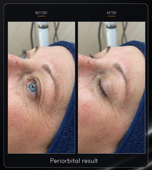 Eye-area before-and-after photographs for NEXCELL BOTA
