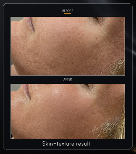 Skin-texture before-and-after photographs for NEXCELL BOTA