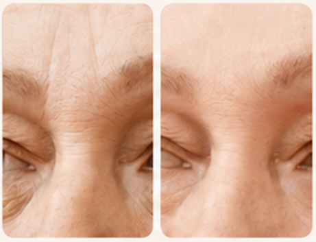 FORAFILL FINE brow and eye-area images before and after