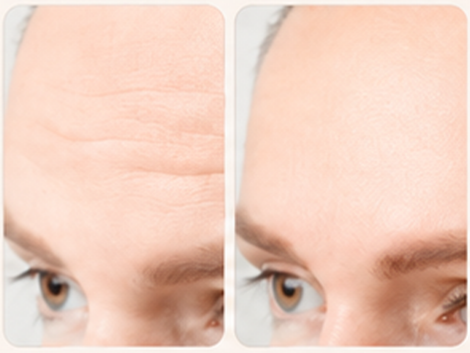 FORAFILL SUB-Q forehead images before and after