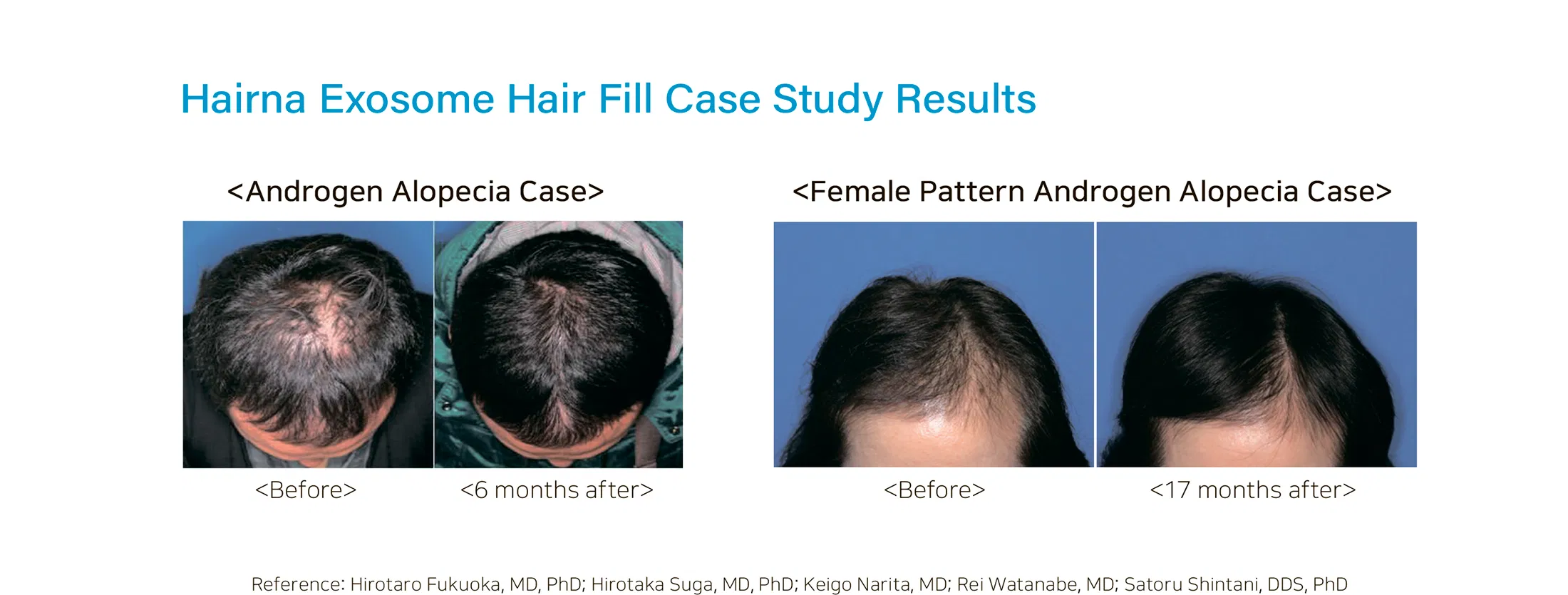 HAIRNA Exosome Hair Fill · información del producto